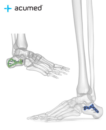 Sistema de Placas de Talón Acumed