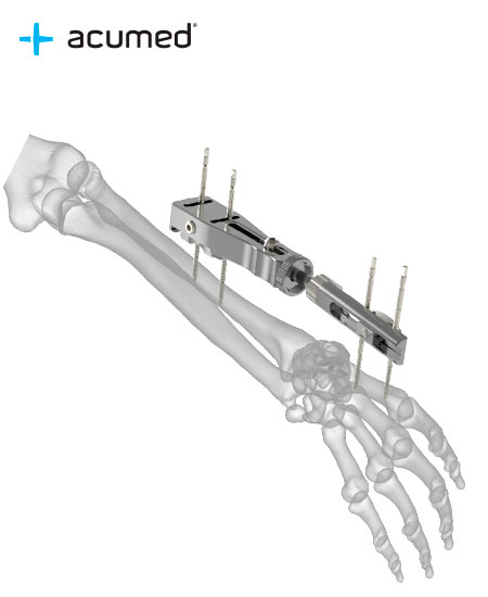 Fijador Externo Acumed
