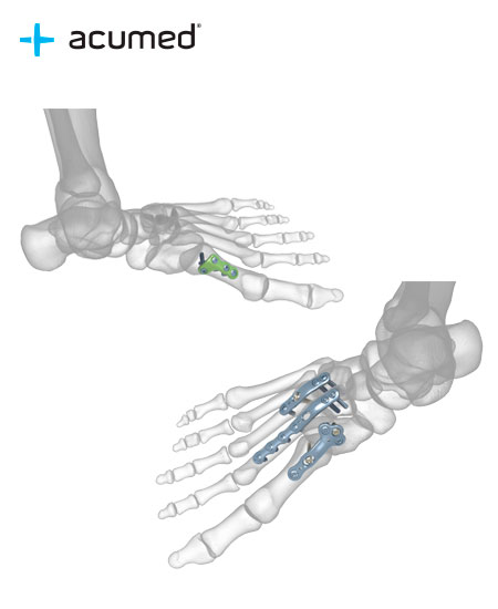 Placas del Antepié y Mediopié Acumed